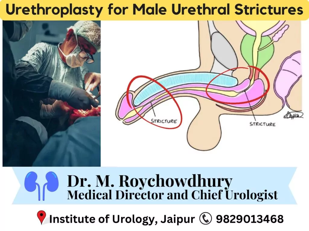 Urethroplasty for Male Urethral Strictures Dr M Roychowdhury