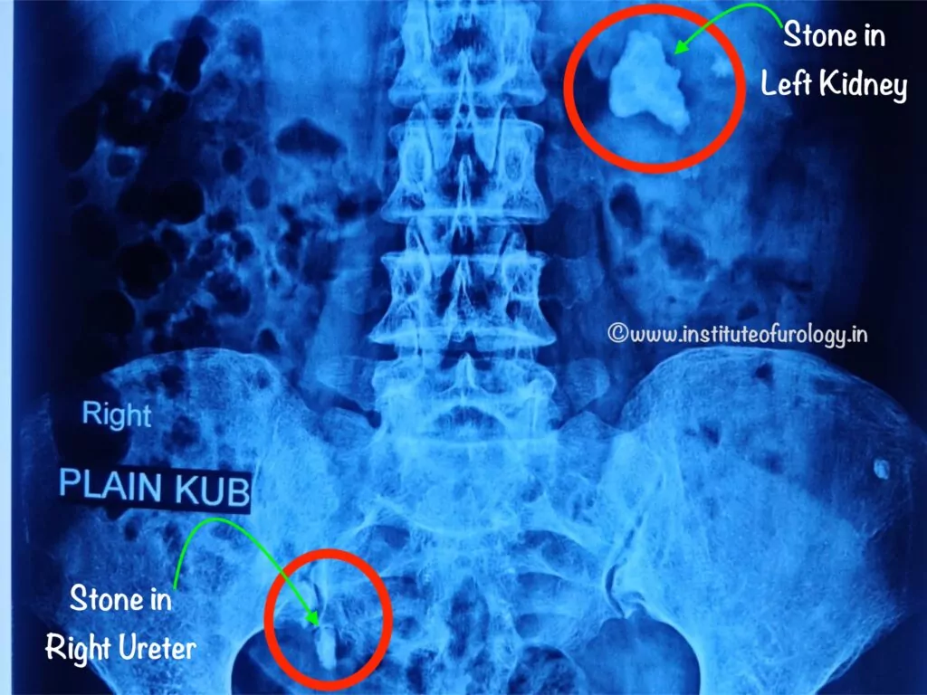 Dual Endoscopic Management of Bilateral Renal and Ureteric Calculi in an Elderly Patient at Institute of Urology, Jaipur Dr Rajan bansal Dr M Roychowdhury