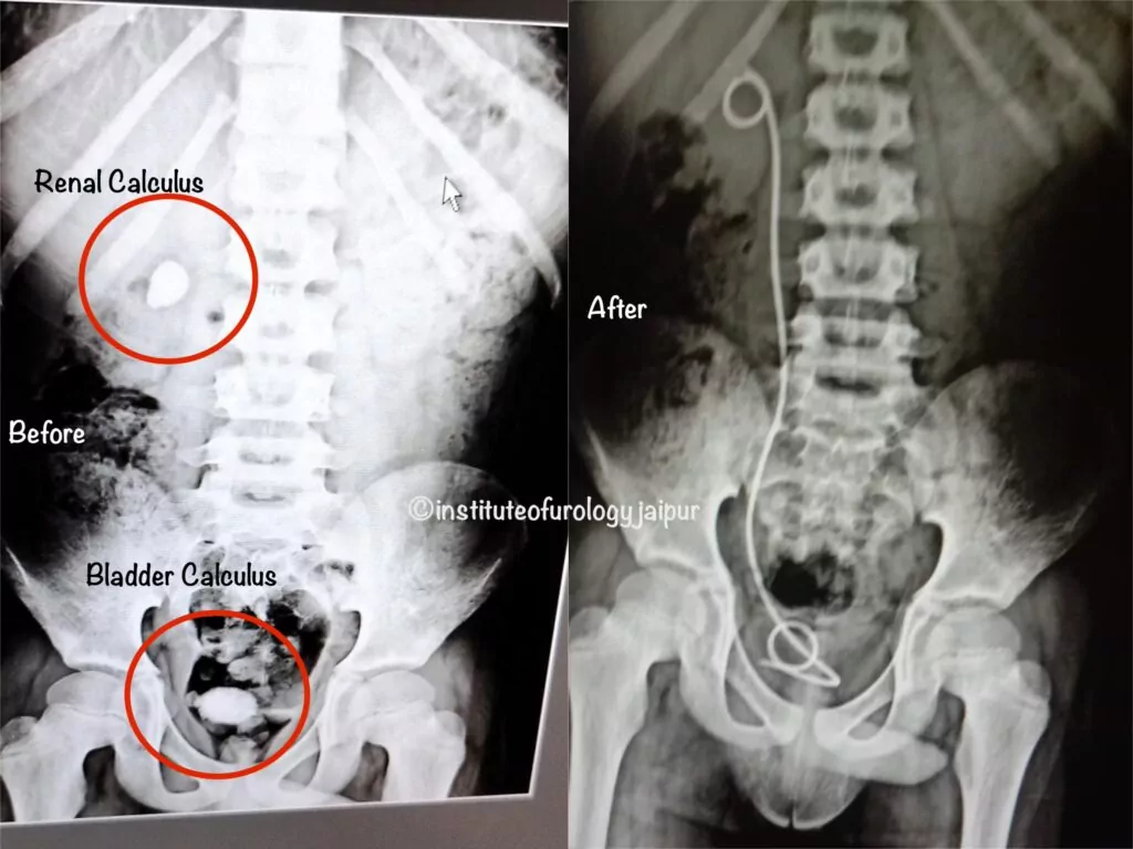 Urinary Bladder and Renal Calculi in a 10-Year-Old Child