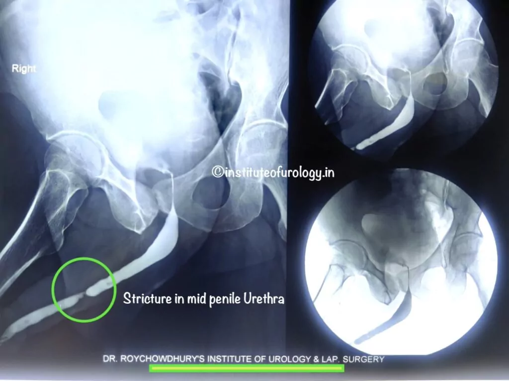 Best Hospital for Urethroplasty in Jaipur - Dr. M Roychowdhury Dr Rajan Bansal Best urologist RGU Image Stricture Urethra HD