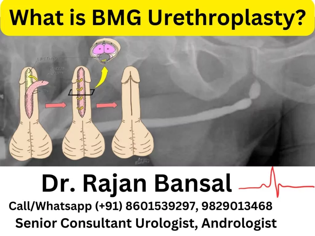 What is BMG Urethroplasty? Dr M Roychowdhury Dr Rajan Bansal