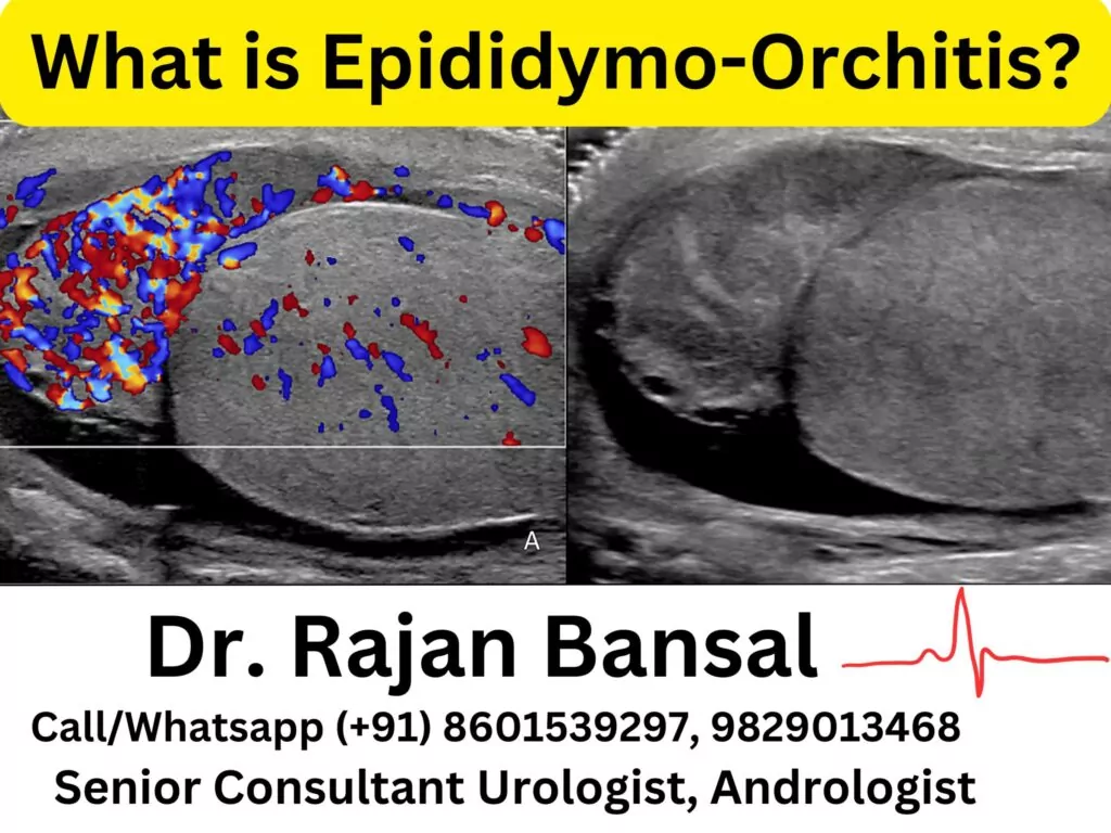 What is Epididymo-Orchitis? Dr. M Roychowdhury Dr. Rajan Bansal