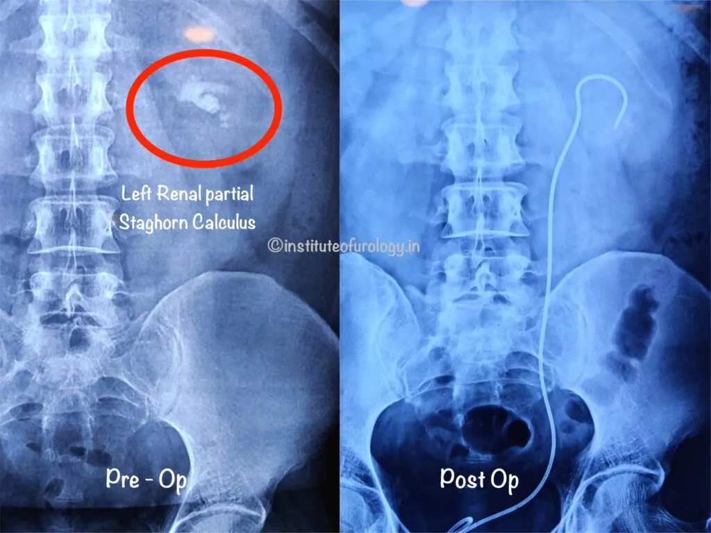 Large Staghorn Calculus treatment by rirs by no cut on the body Institute of Urology, Jaipur Dr Rajan Bansal Dr M Roychowdhury