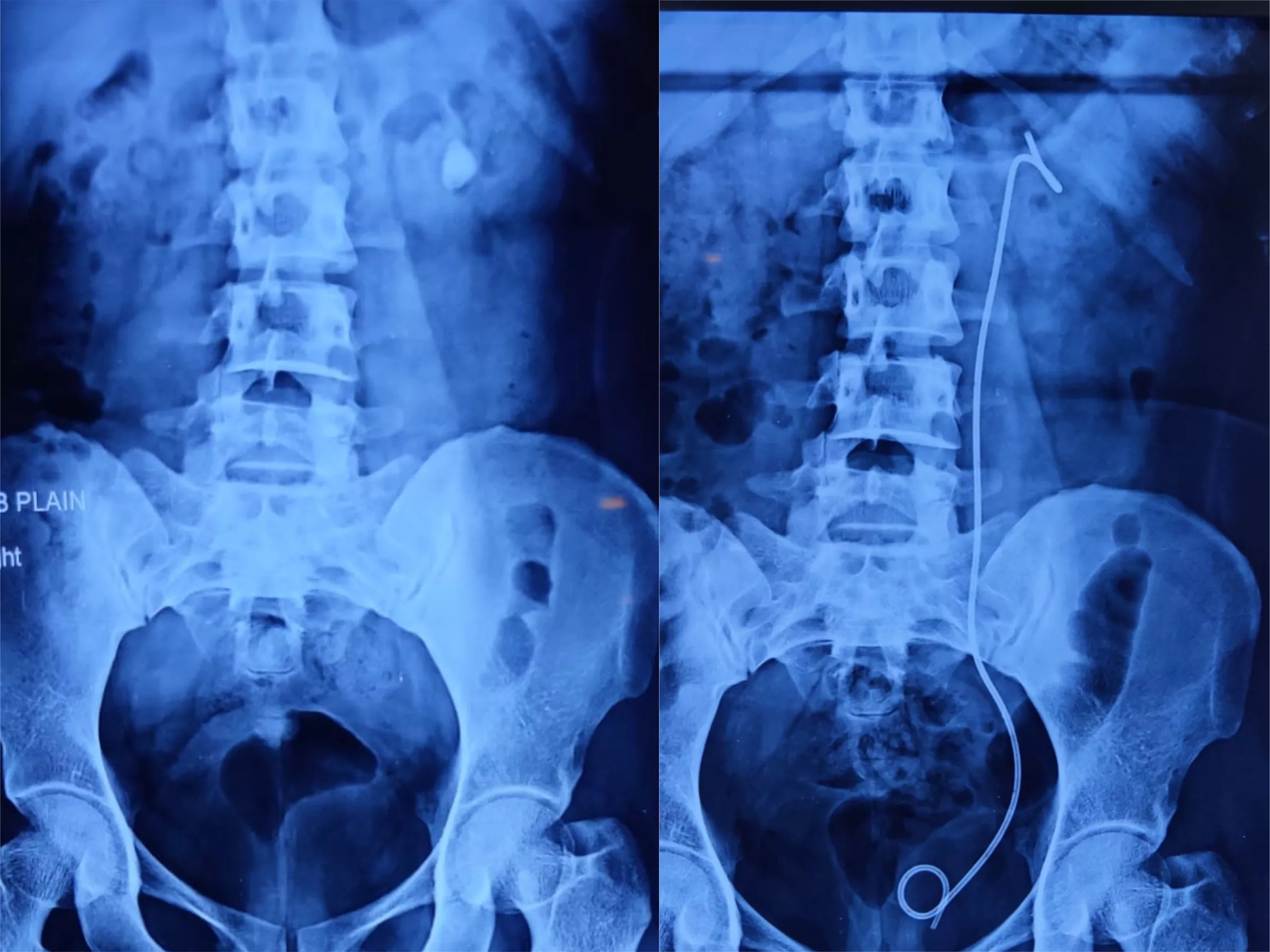 Best Hospital for Kidney Stone Treatment by PCNL in Jaipur