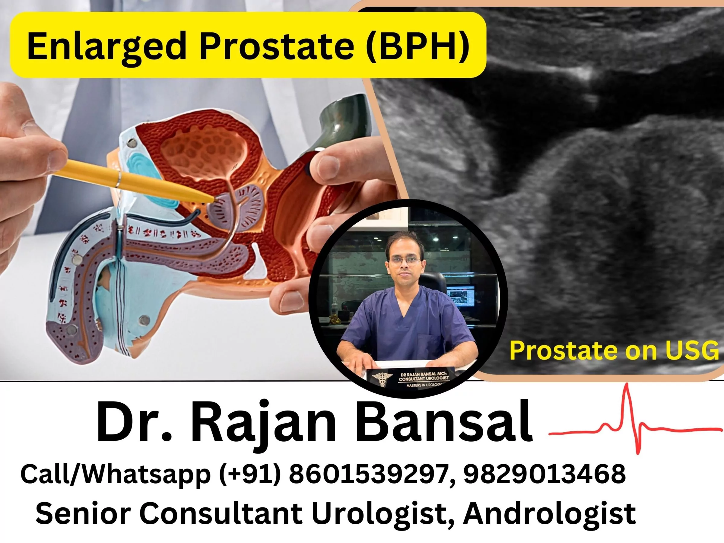 Enlarged Prostate (BPH)- Symptoms Every Man Over 50 Should Watch For Dr Rajan Bansal Dr M Roychowdhury