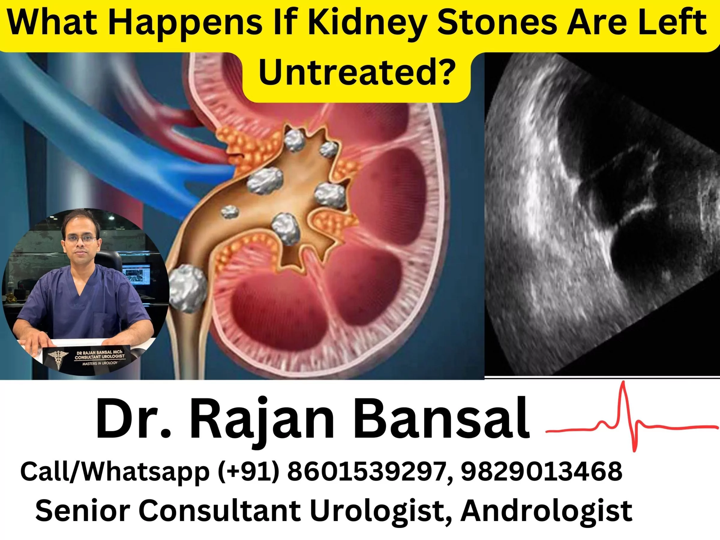What Happens If Kidney Stones Are Left Untreated? Dr M Roychowdhury Dr Rajan Bansal