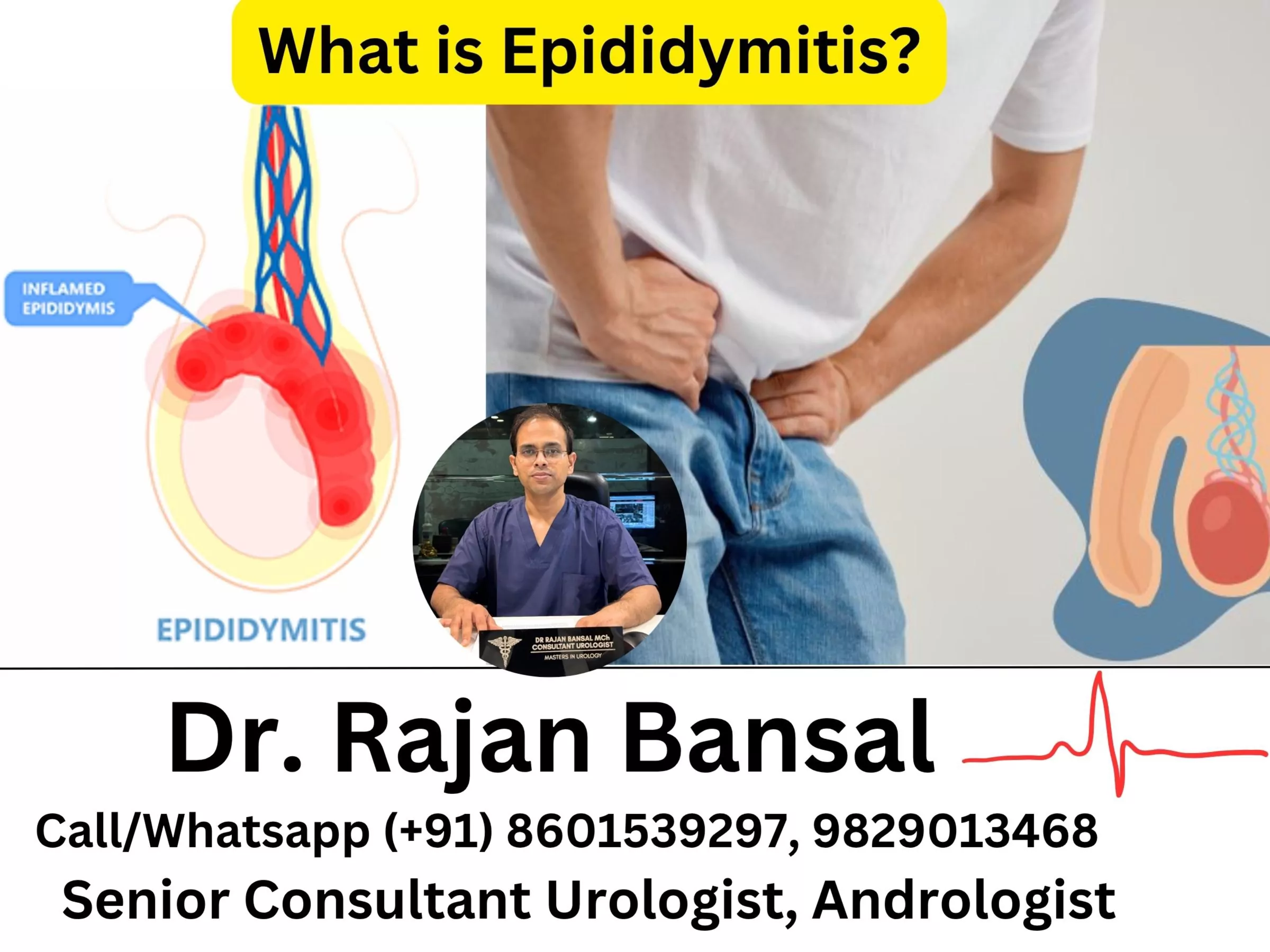 What is Epididymitis? A Complete Guide Dr M Roychowdhury Dr Rajan Bansal