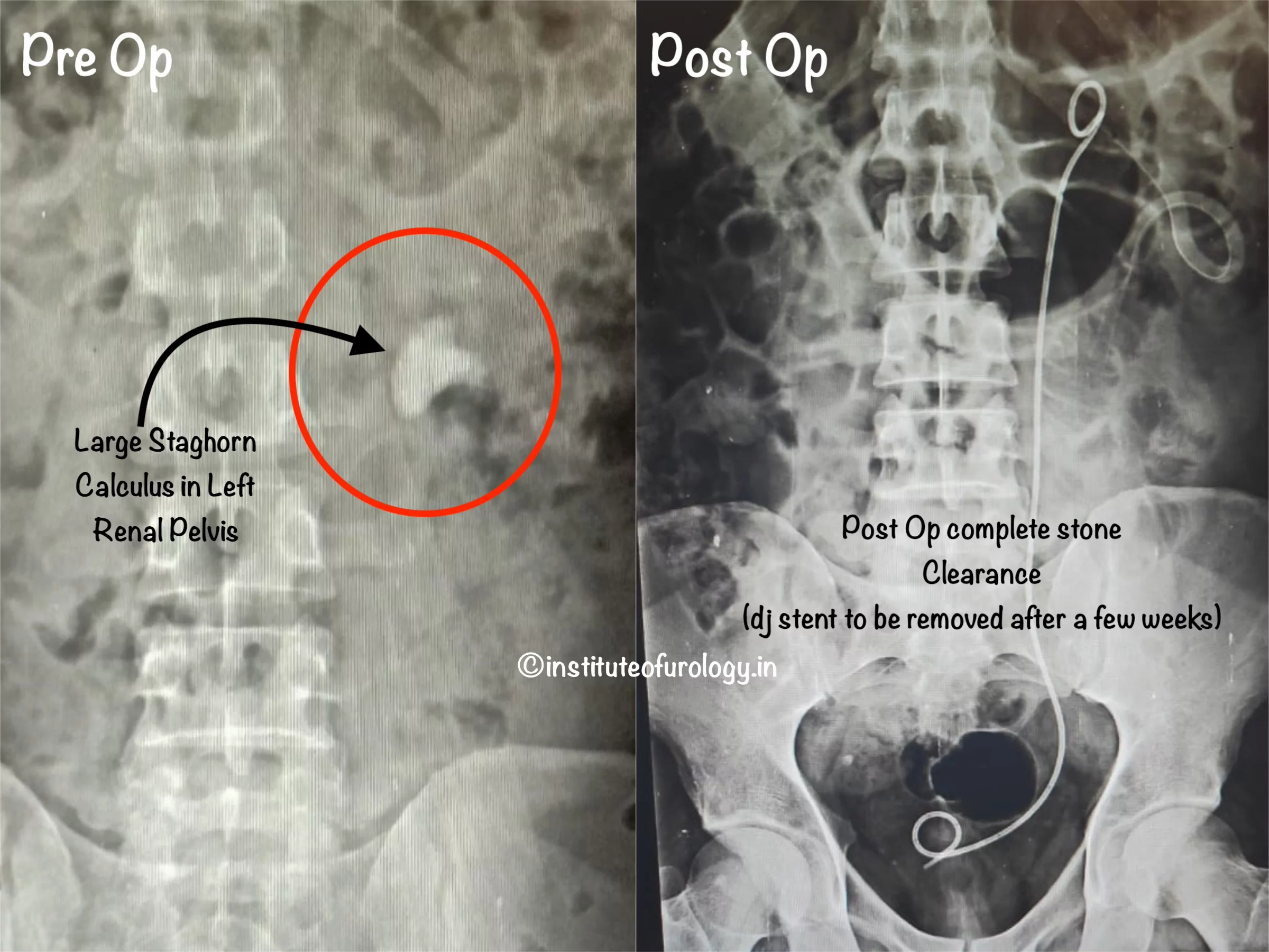 Best Hospital for Large stone surgery PCNL Institute of Urology, Jaipur