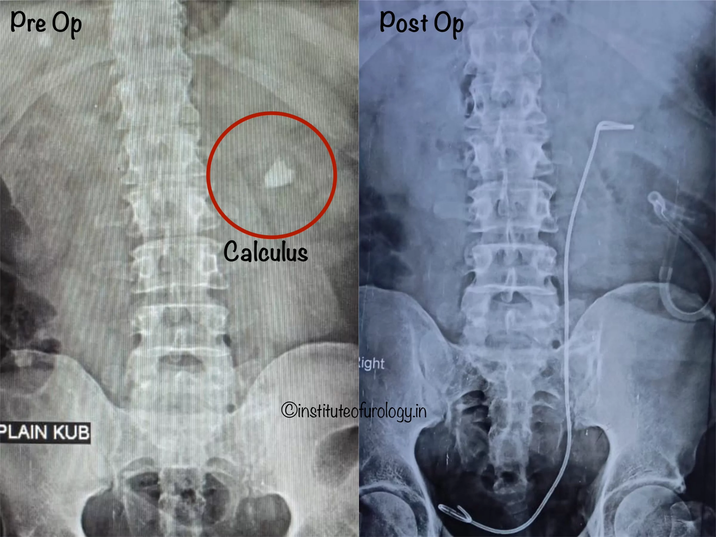 Percutaneous Nephrolithotomy for Large Renal Pelvic Calculus in a High-Risk Patient