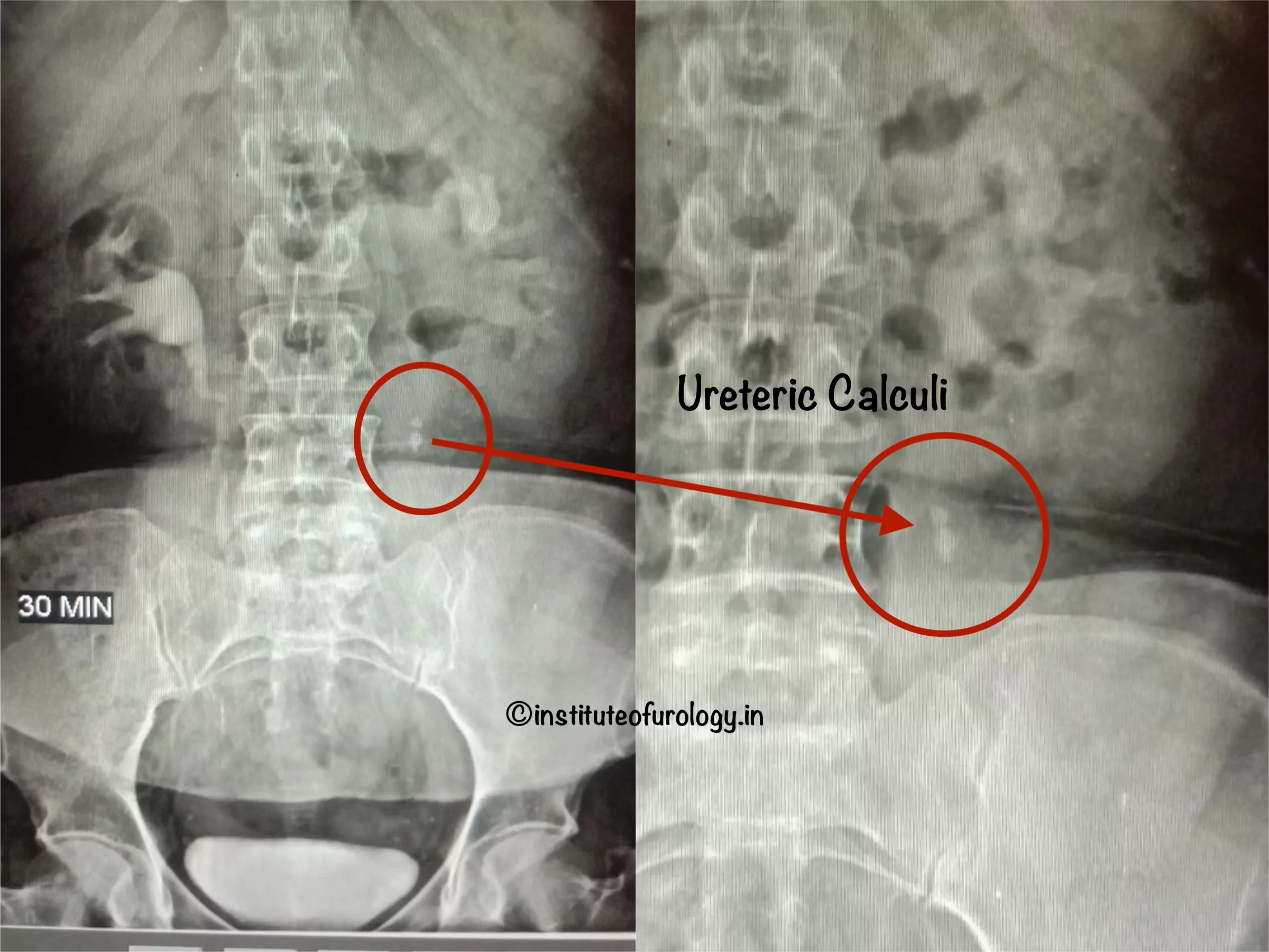 RIRS for Upper Ureteric Calculus with Hydronephrosis