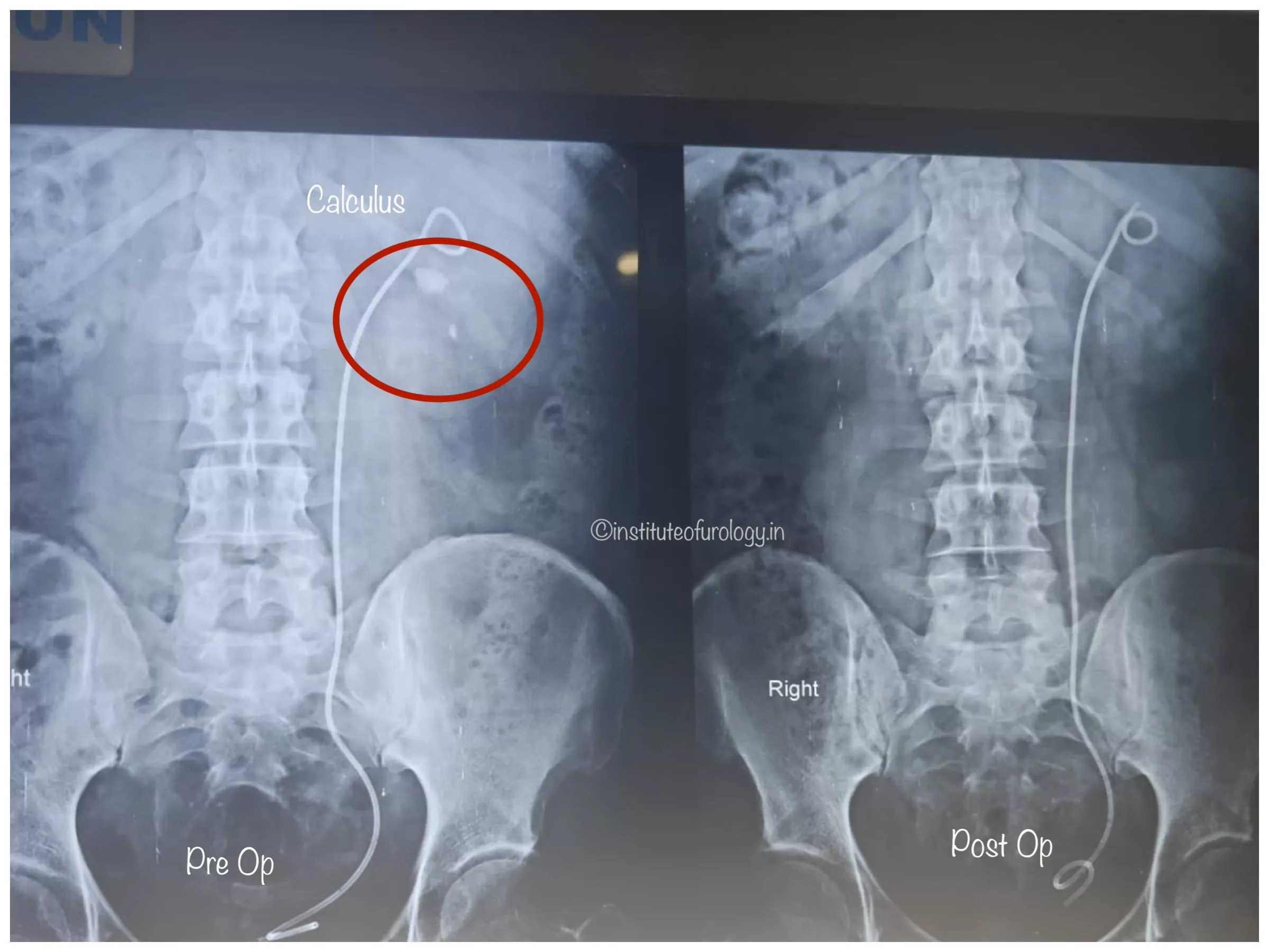 Successful Management of Left Renal Pelvic and Lower Calyceal Calculi Using Flexible Ureteroscopy (RIRS) Following Prior DJ Stenting