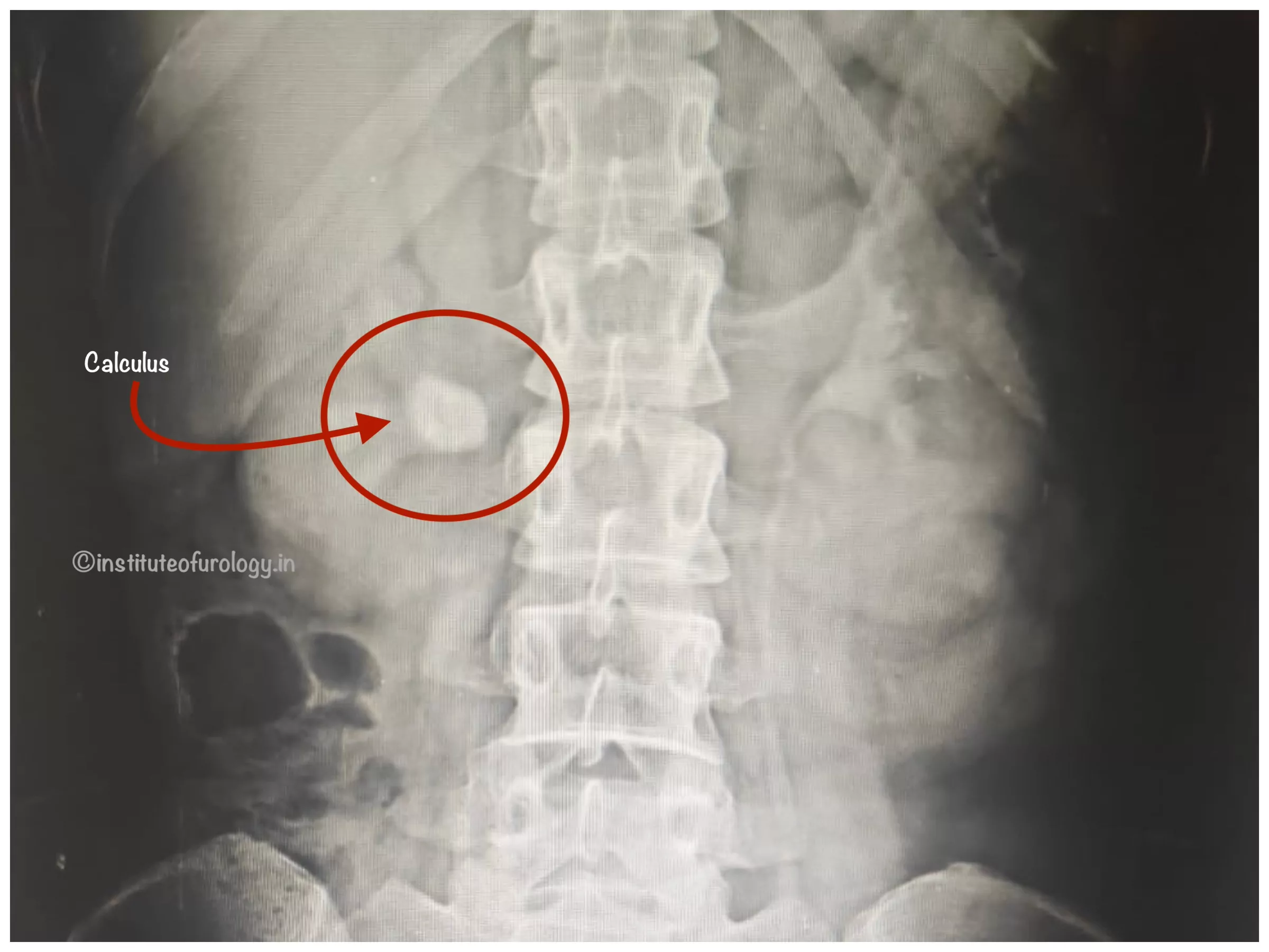 rirs for 20 mm right renal calculus